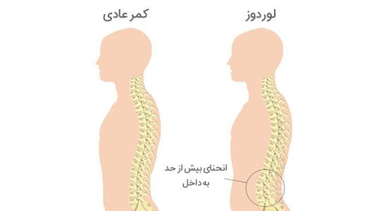 درمان گودی کمر با ورزش